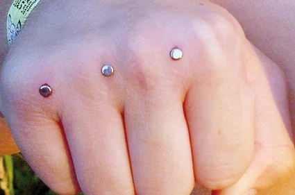 عوارض کاشت نگین در پوست؛ از عفونت تا مشکلات پوستی عوارض کاشت نگین در پوست؛ از عفونت تا مشکلات پوستی