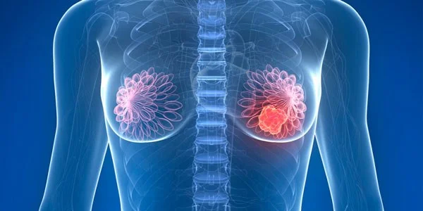سرطان سینه چیست؟ + 4 روش درمان و قطعی سرطان پستان