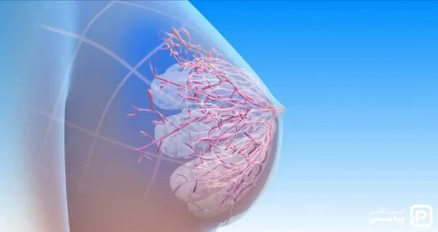 سرطان سینه چیست؟ + 4 روش درمان و قطعی سرطان پستان