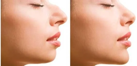 همه چیز درباره عمل بینی؛ انواع عمل زیبایی بینی و روش های جراحی