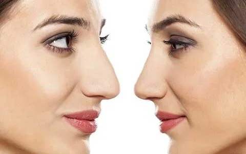 همه چیز درباره عمل بینی؛ انواع عمل زیبایی بینی و روش های جراحی