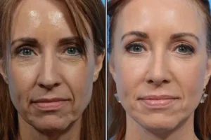 آشنایی با تزریق چربی، مزایا و معایب آن (مراقبت های بعد از تزریق)