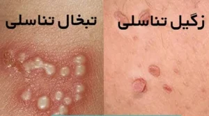 علائم و نشانه های تبخال تناسلی؛ انواع تبخال، تشخیص آن و روش های درمان