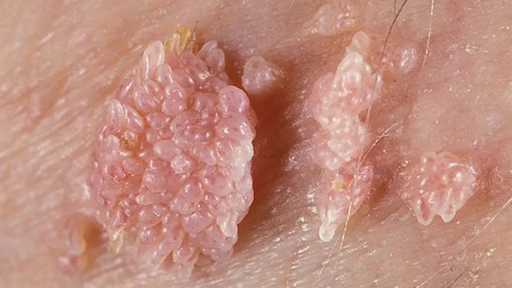 تصویر آموزشی درباره ویروس پاپیلومای انسانی یا HPV