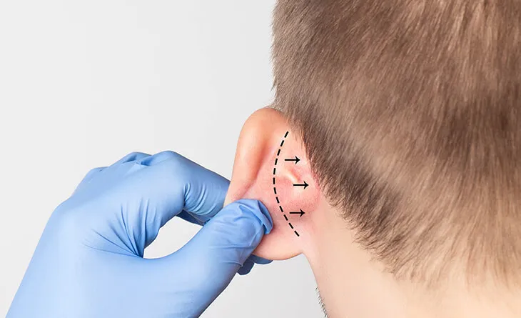 melinic otoplasty 3