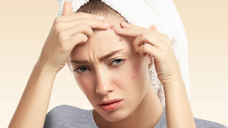 جوش صورت و انواع آن‌ها (دلیل انواع جوش چرکی، سرسیاه و ...)